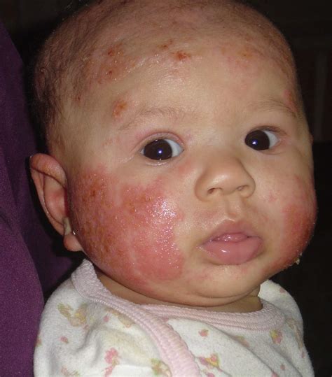 Baby Acne Cure And Treatment Baby Eczema Pictures What Looks Like