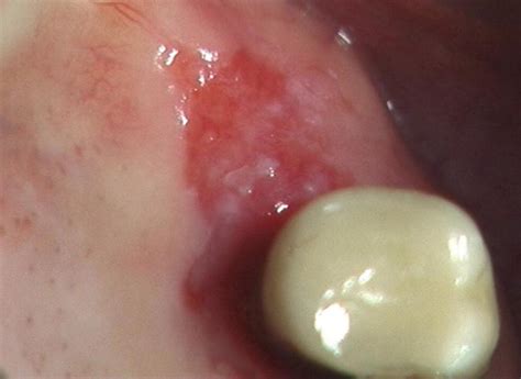 Red And White Lesions Of The Oral Mucosa Pocket Dentistry