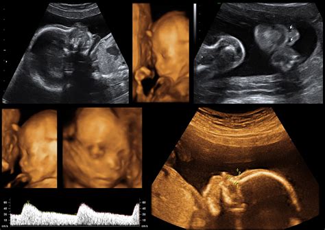 Sonograms And 3d Ultrasounds Seven Oaks Womens Center San Antonio Tx