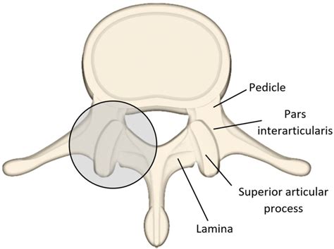 Illustration Of Lumbar Vertebra Highlighting The Postero Lateral Aspect