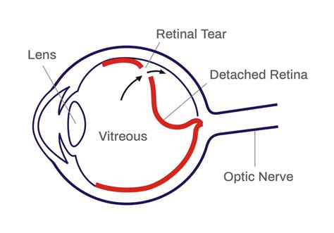 Retinal Detachment Dr Rehman Siddiqui