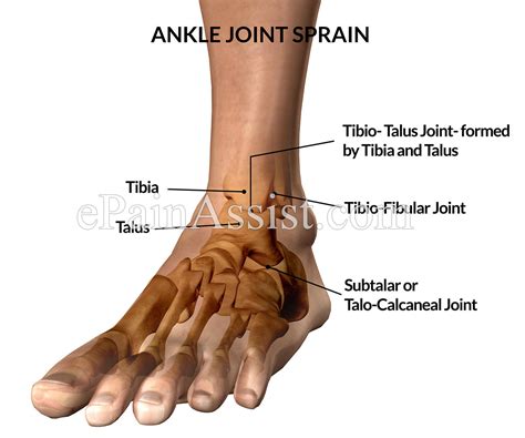 Ankle Joint Spraincausestypessymptomstreatment Conservative