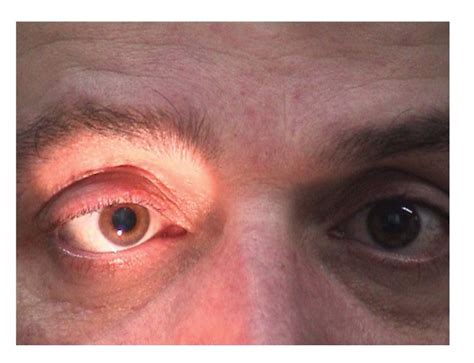 Bilaterally Dilated Pupils With Absent Response To Light When Light Is