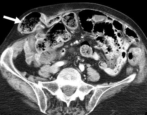Ct Scan Of The Abdomen And Pelvis Showing The Uretero Inguinal Hernia