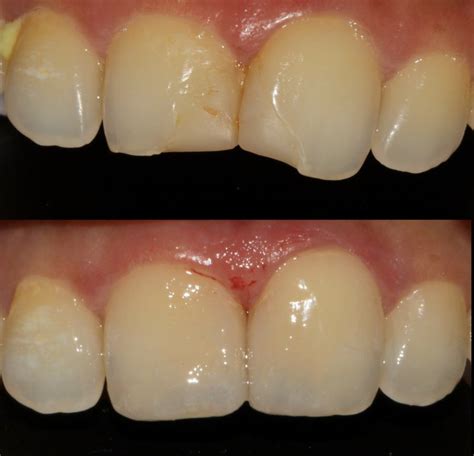 Composite Restorations For Aesthetic Correction Of A Single Anterior Tooth