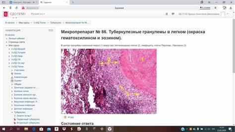 Диета при лимфоме не ходжкина Лимфоузел при лимфоме Ходжкина (№ 90) Лимфоузел при лимфоме Ходжкина (№ 90) Диета при лимфоме не ходжкина