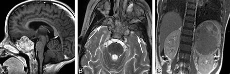 Sphenoid Masses In Children Radiologic Differential Diagnosis With
