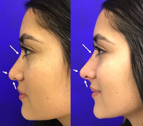 Non Surgical Nose Job Cost California Lissa Burrows