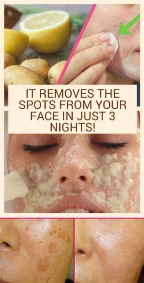 How To Get Rid Of Brown Spots On Deal With Brownspotsonfacetreatment