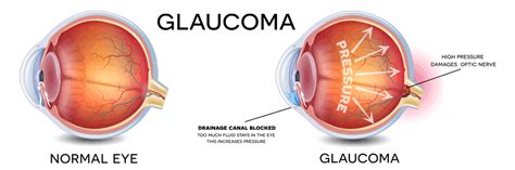This causes the cup to become larger in comparison to the optic disc, since the support structure is not there. Glaucoma Health Message at Fresh Therapeutics | Fresh ...