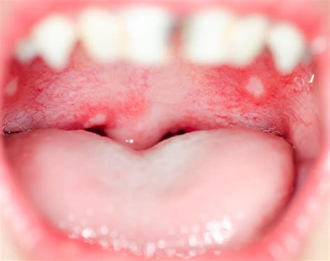 The 6 Most Common Mouth Infections In Children