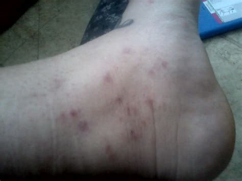 So I Have A Red Bumpy Itchy Like Crazy Rash On My Forearms