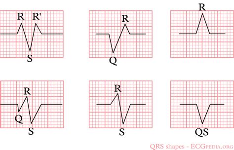 EKG interpretation basics - wikidoc