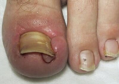 Carefully pull skin away from your ingrown toenail with a small nail file that's blunt and won't cut your toe. INGROWN NAIL SURGERY - Total Care Podiatry