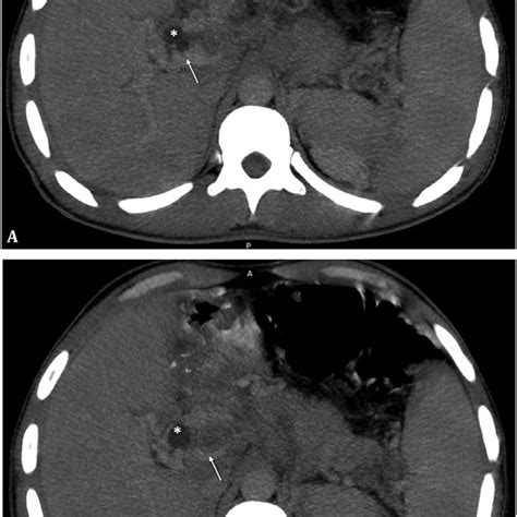 Axial Abdominal Ct Scan Images Demonstrating Enlarged Lymph Nodes With