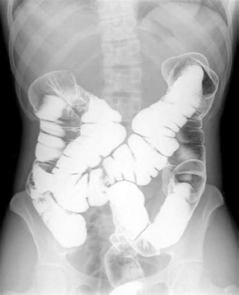 Image Double Contrast Barium Enema Showing Normal Anatomy Merck