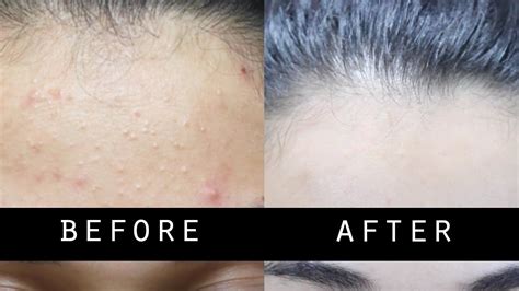Get Rid Of Small Pimples And Lighten Skin Naturally Fast Forehead