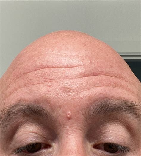 Sebaceous Hyperplasia Before And After