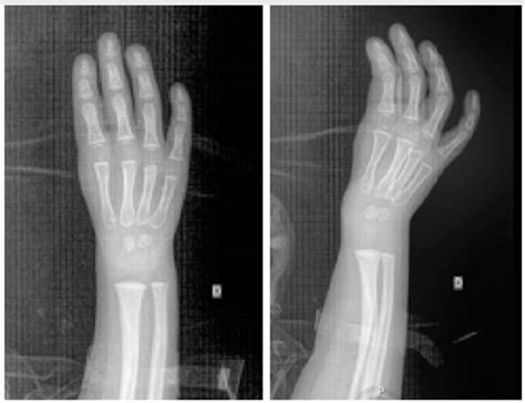 X Ray Of The Right Hand In Anteroposterior And Oblique Projection