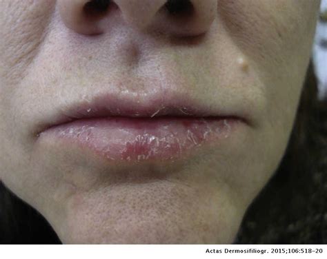 Dyshidrotic Eczema On The Lips