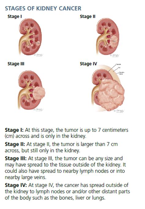 Stage 4 Renal Cancer Doctorvisit