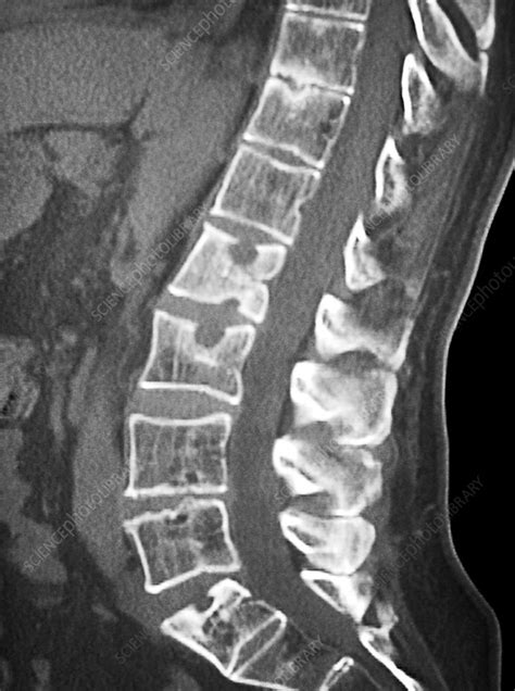 Ankylosing Spondylitis Spine Ct Scan Stock Image C0215440