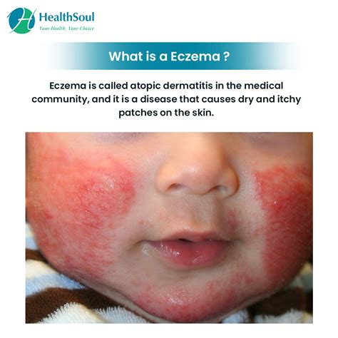 Symptoms Causes Types And Treaments Of Eczema Find Local Hot Sex Picture