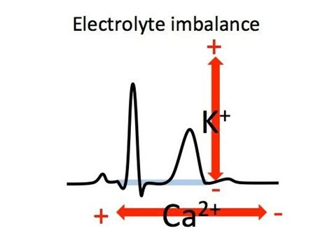 Electrolyte Imbalances EKG Emergency Nursing Medical Babe Studying Medical Babe Motivation