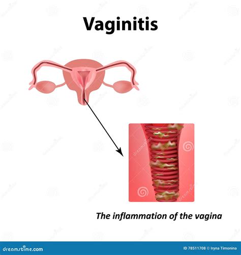 Inflammation Of The Vagina Vaginitis Infographics Vector