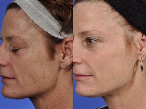 Bbl And Ipl Photofacial Procedures In Philadelphia Pa W Cosmetic