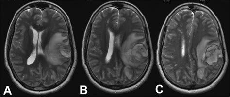 Axial T1W image (A) showing hyperintense lesion in right ...