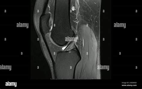 Magnetic Resonance Images Of The Knee Joint Sagittal Proton Density