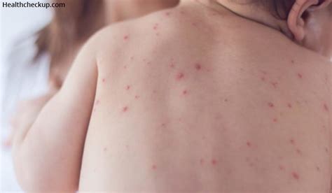 Viral Rashes In Children Causes Symptoms And Prevention