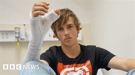 australian man s thumb surgically replaced by toe