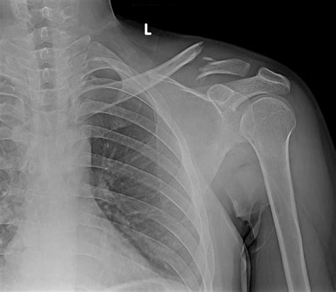 Right Acromioclavicular Joint Injury On Chest Xray