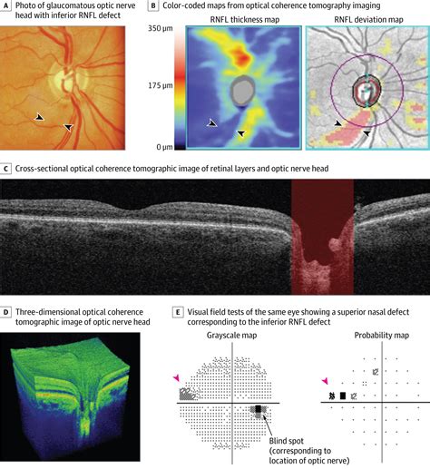 Pathophysiology And Treatment Of Glaucoma Genetics And Genomics