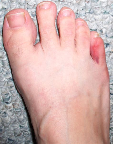 Sprained Pinky Toe Or Broken Pinky Toe Home Treatment