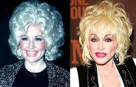 Dolly Parton Before And After Plastic SurgeryNew Celebrity