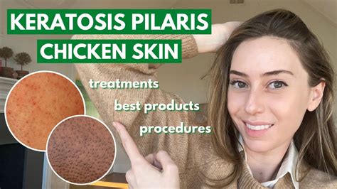 Keratosis Pilaris How To Treat Dry Bumpy Skin Aka Chicken 52 Off
