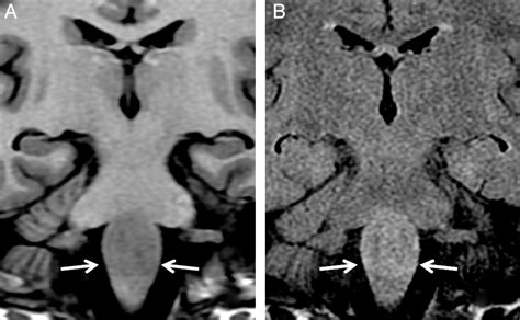 Isolated Brain Stem Lesion In Children Is It Acute Disseminated