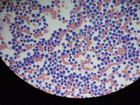 La leucemia mieloide crónica (chronic myeloid leukemia, cml), también conocida como leucemia mielógena crónica o leucemia granulocítica crónica, es un tipo de cáncer que se inicia en las células hematopoyéticas de la médula ósea y que invade la sangr Convivir con la leucemia mieloide crónica y mantener ...