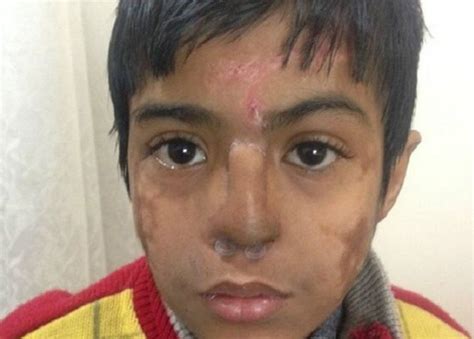 Indian Doctors Grow New Nose On Boys Forehead Bbc News