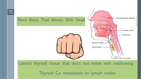 Surgery Shelf Review Thyroid Nodules Youtube