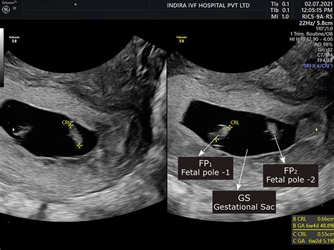 cureus successful management of triplet heterotopic pregnancy interstitial with an