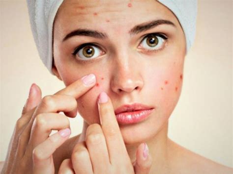 Acne Causes And Treatment Doctor Zara