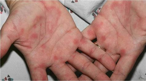 Itchy Scaly Rash On Palms Of Hands