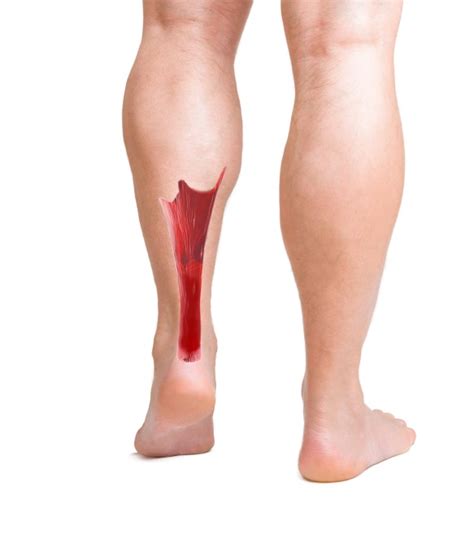 The more common tendon injuries include the lateral and medial epicondyle tendons (extensor origin and flexor origin) and the distal bicep tendon(5). Why does cipro cause tendon ruptures,Half life of levaquin ...