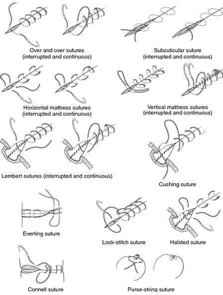 Surgical Sutures Stitches Medical Medical Knowledge Surgical Suture