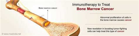 We know what goes into our remedies, so we know what you'll get out of them. Bone Marrow Cancer: New Insights into Boosting Tumor ...