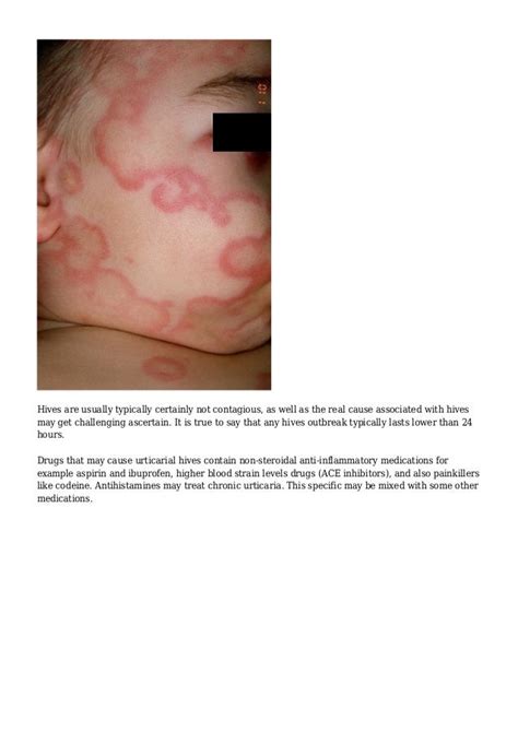 The Recommended Method For Treating Ones Urticaria Hives Is To Learn